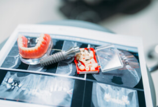 Protetika v ESTEMO Tábor